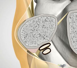 Querschnitt der Peronealsehnen in Höhe des Sprunggelenks.