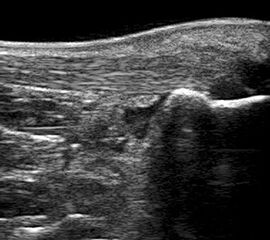 Bursitis subachillea als echoarme Struktur an der kranialen Kante des Kalkaneus.