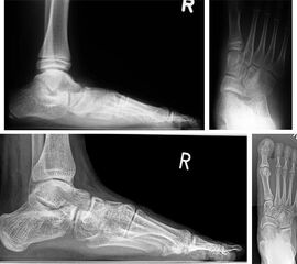 Zum Operationszeitpunkt 11-jähriger Junge mit großer Coalitio talocalcanearis (Längsausdehnung 25 mm, Querausdehnung 15 mm) und ausgeprägter kontrakter Planovalgus-Deformität (a und b). 4 Jahre nach Coalitio-Resektion, Fett-Interposition,
