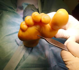 Typisches Bild einer statischen Metatarsalgie mit schmerzhafter plantarer Hyperkeratose (eigenes Bildarchiv)