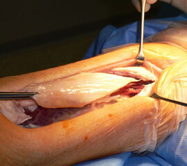 Mit Hilfe der V-Y-Plastik können Defekte bis ca. 3 cm gut überbrückt werden.