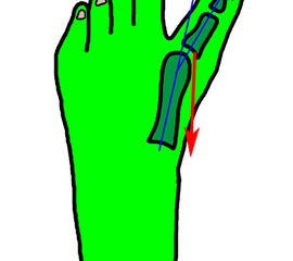 Der Hallux varus Winkel  <a class=