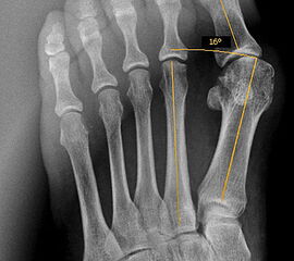 Operationsplanung anhand der Röntgenaufnahmen unter Beachtung wichtiger radiologischer Landmarks wie Intermetatarsalwinkel, Hallux valgus – Winkel, Distaler Gelenkflächenwinkel (Distal metatarsal articular angulation: DMAA), Metatarsaleindex und S