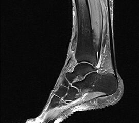 Bildgebende Diagnostik bei der Ruptur des MTA mittel MRT: 
Sagitaler Schnitt  mit Darstellung des nach proximal retrahierten Stumpfes der rupturierten Sehne.