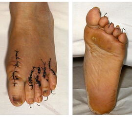 Klinisches Bild eines Fußes zehn Tage postoperativ nach Stainsby Prozedur.