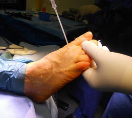 Ausgiebige Spülung mit der Knopfkanüle