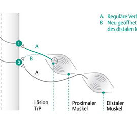 Konvergenz-Projektionstheorie (modifiziert nach: Mense, S.; 2001): Durch Öffnen von ineffektiven Synapsen (B) wird die nozizeptive Erregung eines mit Triggerpunkten besetzten Muskels, der normalerweise über das Hinterhornneuron 1 mit dem R