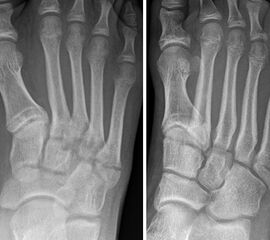 Lawrence und Botte Zone II