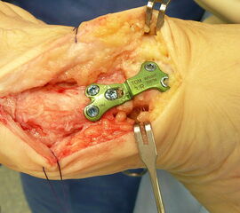 TOM Platte fixiert (Photo)