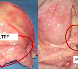 Das Ligamentum talofibulare posterius