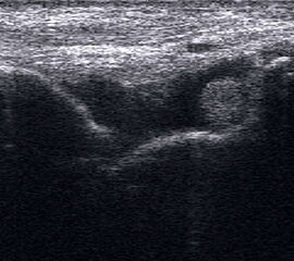 Hämarthros mit Binnenechos