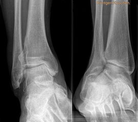 Auf dem linken Bild (a) Varusarthrose des oberen Sprunggelenks mit deutlicher Mehrbelastung der medialen Gelenkanteile. Dort bereits deutlich sichtbarer Knorpelverlust. Rechtes Bild (b) Valgusarthrose des oberen Sprunggelenks. Erhöhte Druckbelastung in de