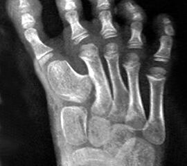 Angeborene Deformität und Fehlanlage 1. Strahl (eigenes Bildmaterial) (Vispo-Seara 1998, Hefti 1998)