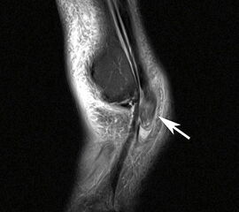 Ruptur der Peronaeus longus Sehne mit proximalisiertem Sehnenstumpf im MRT