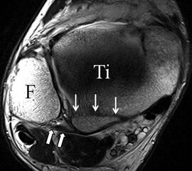 b. T2 fs axial. Infraktion des hinteren Volkmann‘schen Dreiecks (schmale, weiße Pfeile). Hier inserierende, intakte, hintere Syndesmose (breite, weiße Pfeile).