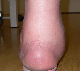 Schlecht gefertigte Einlage. Der Fuß „hängt“ über die Ränder der Einlage. Bei einem Patienten mit Neuropathie wie in diesem Fall kann dies rasch zu Ulzerationen durch den Druck am Rand der Einlagen führen.