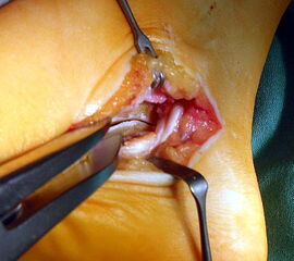 OP-Situs nach Resektion einer talocalcanearen Coalitio. Mit einem Knochenspreizer kann das Talocalcanealgelenk vorsichtig mobilisiert werden.