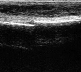 Fibulafraktur mit Unterbrechung der Kortikalis und Hämatom.