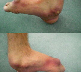 Abbildung 1: Extremer Knick-Hackenfuß beidseits mehr massiven Druckstellen aber ohne Beschwerden. Patient läuft sicher mit Konfektionsschuhen und wünscht keine operative Behandlung.