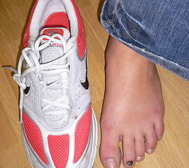 Bluterguss unter dem Nagel der 2. Zehe bei zu kurzem Sportschuh Bluterguss unter dem Nagel der 2. Zehe bei zu kurzem Sportschuh