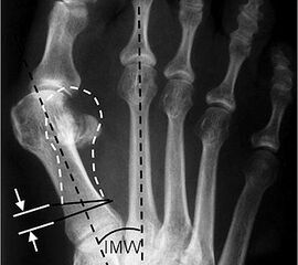 Präoperative Planung. Ziel ist es, den Metatarsalekopf auf den Sesambeinkomplex zu reponieren.