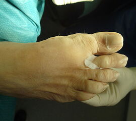 Anlage des ersten Steristripzügels zur Plantarisierung der Zehe.