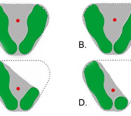 Reduktion der Standfläche bei unterschiedlichen Amputationen am Fuß nach Baumgartner [1].