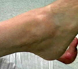 Tendosynovialitis der Peronealsehnen