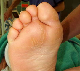 Plantare Schwielenbildung unter dem Metatarsale-II-Köpfchen als Ausdruck einer Überlastung des 2. Strahles oder Schwielenbildungen im Bereich der Beere der Großzehe bei Torsionsfehlstellungen und eingeschränkter Beweglichkeit des Großzehengrundgelenkes