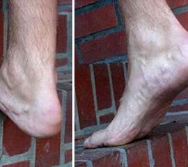 Exzentrisches Krafttraining an einer Stufe mit 6x15 Wiederholungen pro Tag und Bein mit Halten jeder Position für 2s über 12 Wochen täglich.