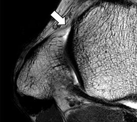Physiologische Bandlücke (Pfeil)