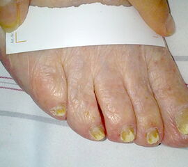 Schwere Nagelpilzerkrankung Schwere Nagelpilzerkrankung