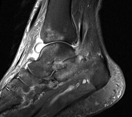 In der Frühphase einer Rheumaerkrankung können mit der MRT bereits Veränderungen an den Gelenken und Weichteilen identifiziert werden, die im konventionellen Röntgen nicht sichtbar sind.