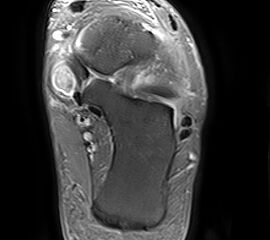 Rupturierte Tibialis posterior Sehne in den coronaren, protonensensitiven Schichten. Bei diskreten Läsionen erhöht die Gabe von Kontrastmittel die Beurteilbarkeit.