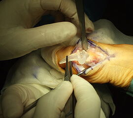 Einbau eines Swanson Spacers