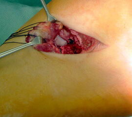 OP-Situs nach Resektion einer calcaneo-navicularen Coalitio bis in die Tiefe des Pfannenbandes. Laterale Anteile des Taluskopfes und der zur Interposition angeschlungene Extensor-digitorum-brevis-Muskel sind erkennbar.
