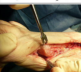 (a) und Schema (b) laterales Release