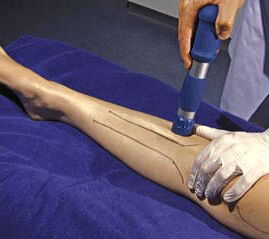 M. tibialis anterior: Behandlung mit der radialen Stoßwelle unmittelbar lateral der Tibiakante. Applikator 20 mm. (Mit frdl. Genehmigung durch Level-10-Buchverlag, Heilbronn und Storz Medical AG)