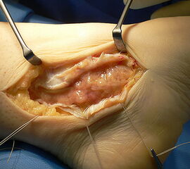 Tendosynovialitis um Bereich des Tarsaltunnels.