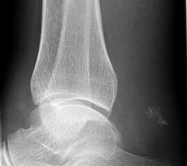 Radiologisches Bild eines knöchernen Ausriss der Achillessehne.