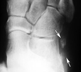 Frakturiertes Os peroneale. Das proximale Fragment ist am Fußaußenrand neben dem Calcaneus erkennbar, das distale Fragment liegt noch in Höhe des Cuboidtunnels.