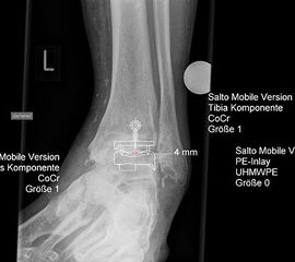 Planung einer Prothesenversorgung am oberen Sprunggelenk.