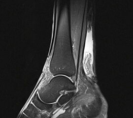 Langstreckige degenerative Ruptur der Achillessehne.
