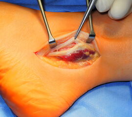 Tief ansetzender Muskelbauch im Verlauf der Peroneus brevis Sehne mit Split der Sehne