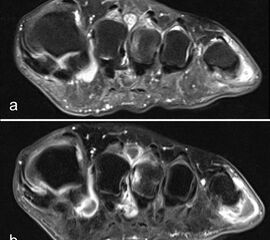 Intermetatarsale Bursitis bei rheumatoider Arthritis mit Erguss (a) und deutlicher Synovialitis in mehreren Schleimbeuteln (b).
