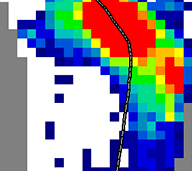 Spreizfuß mit Metatarsalgie, Druckmaximum unter MTK II und III