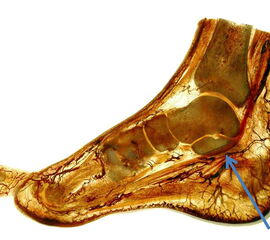 Umschlagpunkt des M. flexor hallucis longus (Pfeil) unterhalb des Sustentaculum tali im Sulcus tendinis musculi flexoris hallucis longi