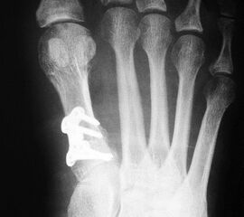 Gutes postoperatives Ergebnis mit physiologischem Intermetatarsale I-II Winkel nach open wedge Osteotomie.