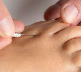 Inzision zur medialen Kapsulotomie.