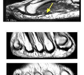 MRT Aufnahmen zeigen das plantare Fettpolster zwischen den beiden Schichten der Plantaraponeurose.
<div style="text-align:left">(a) In der sagitalen Schnittführung des MRTs ist erkennbar, wie die oberflächliche und die tiefe Schicht der Plantaraponeurose